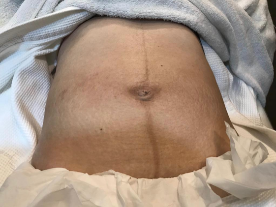 去妊娠紋療程