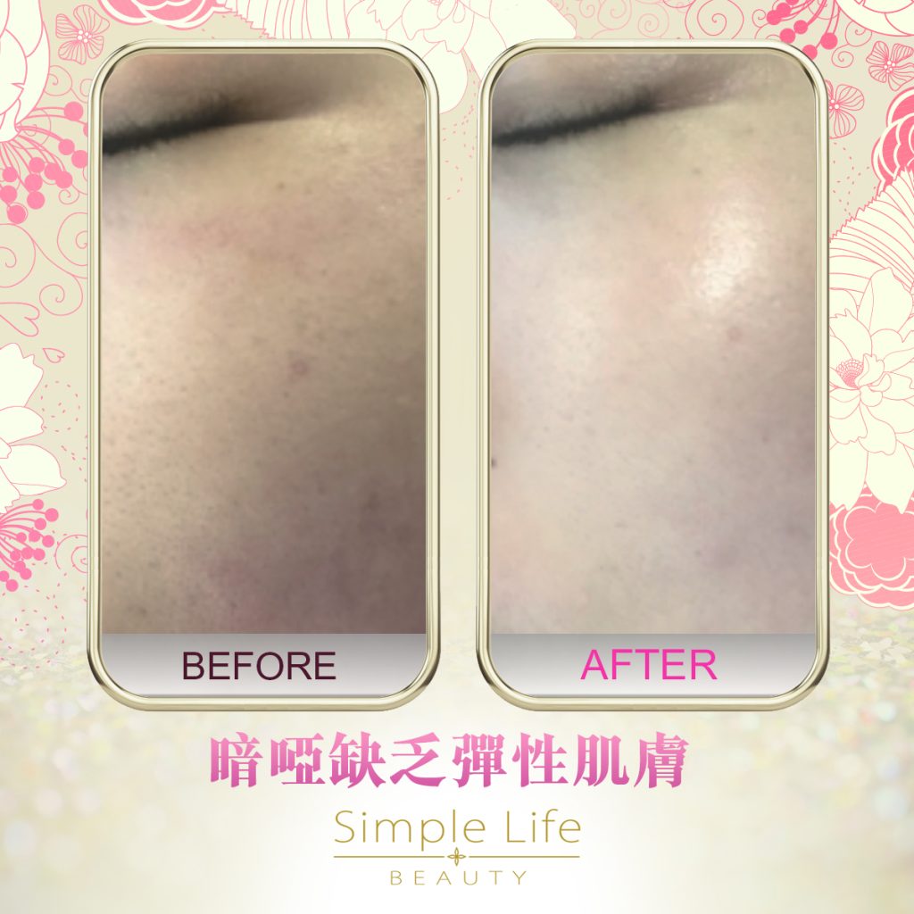 SMTS嬰兒針療程_功效1