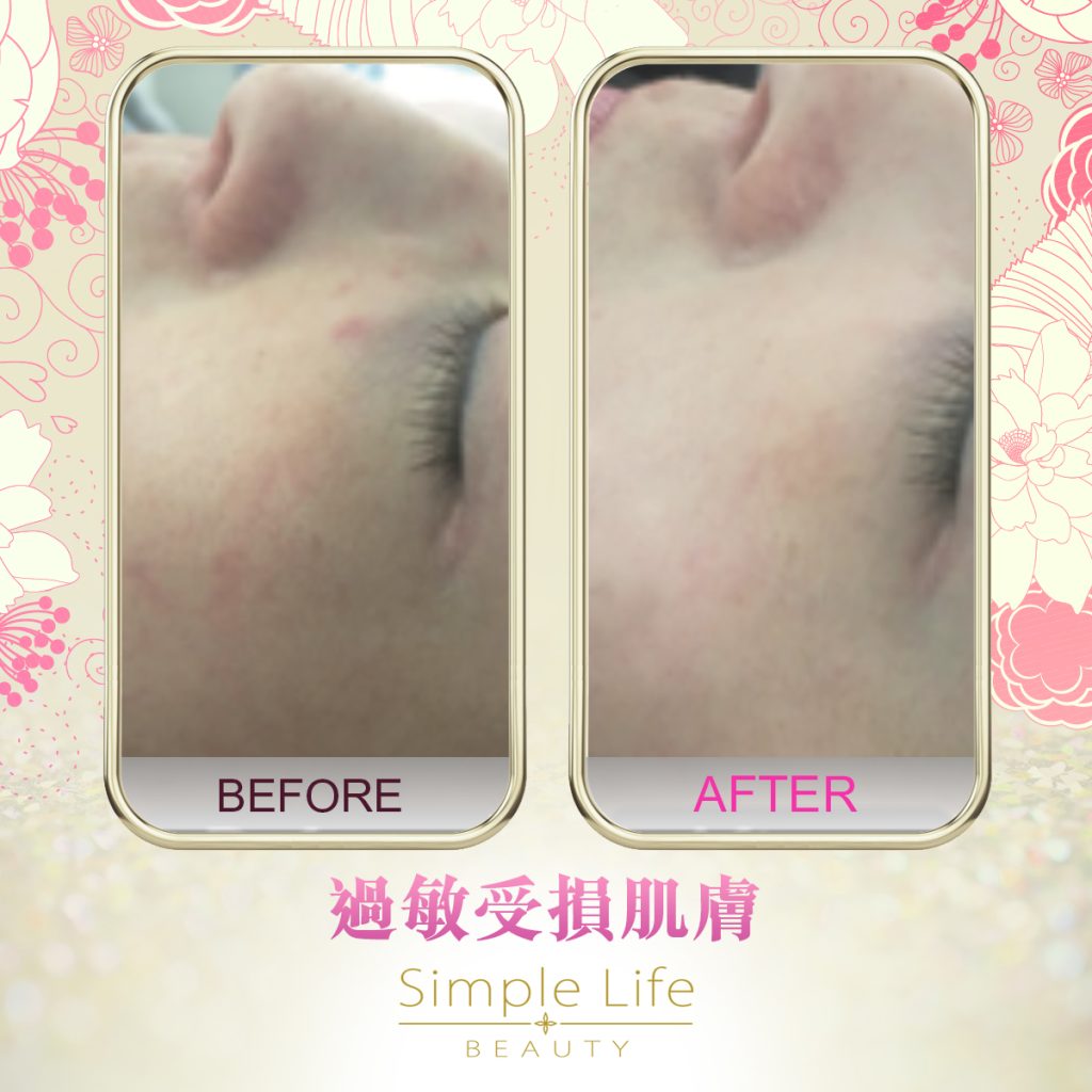 SMTS嬰兒針療程_功效2
