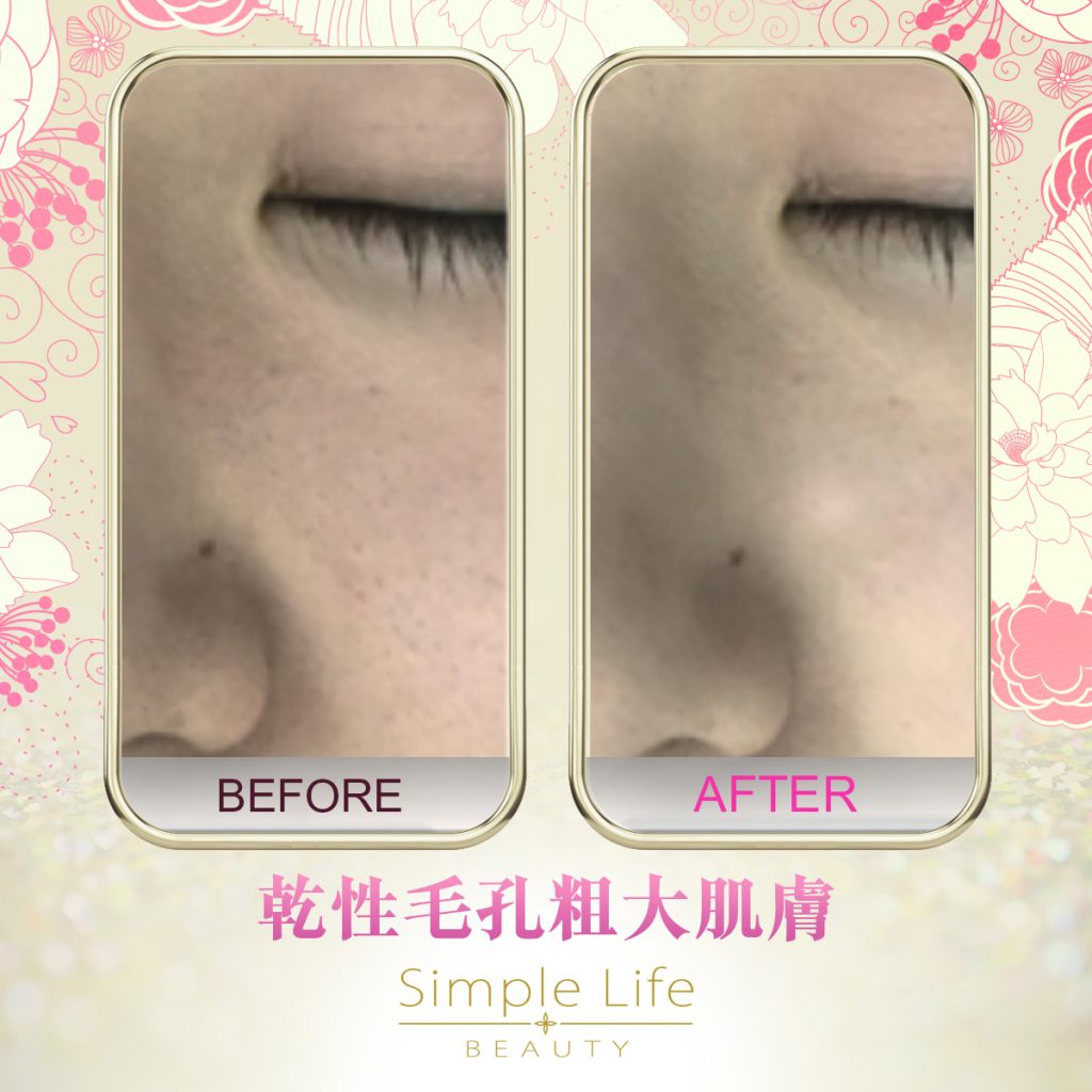 SMTS嬰兒針療程_功效3