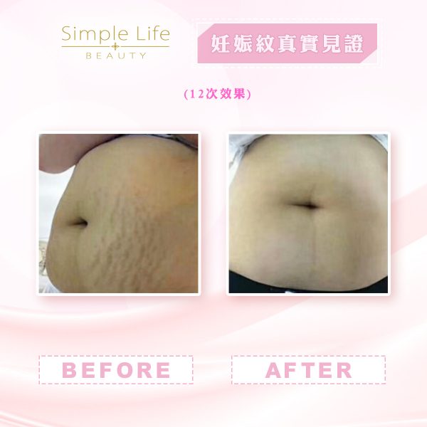 妊娠紋消除療程_肥胖紋消除方法