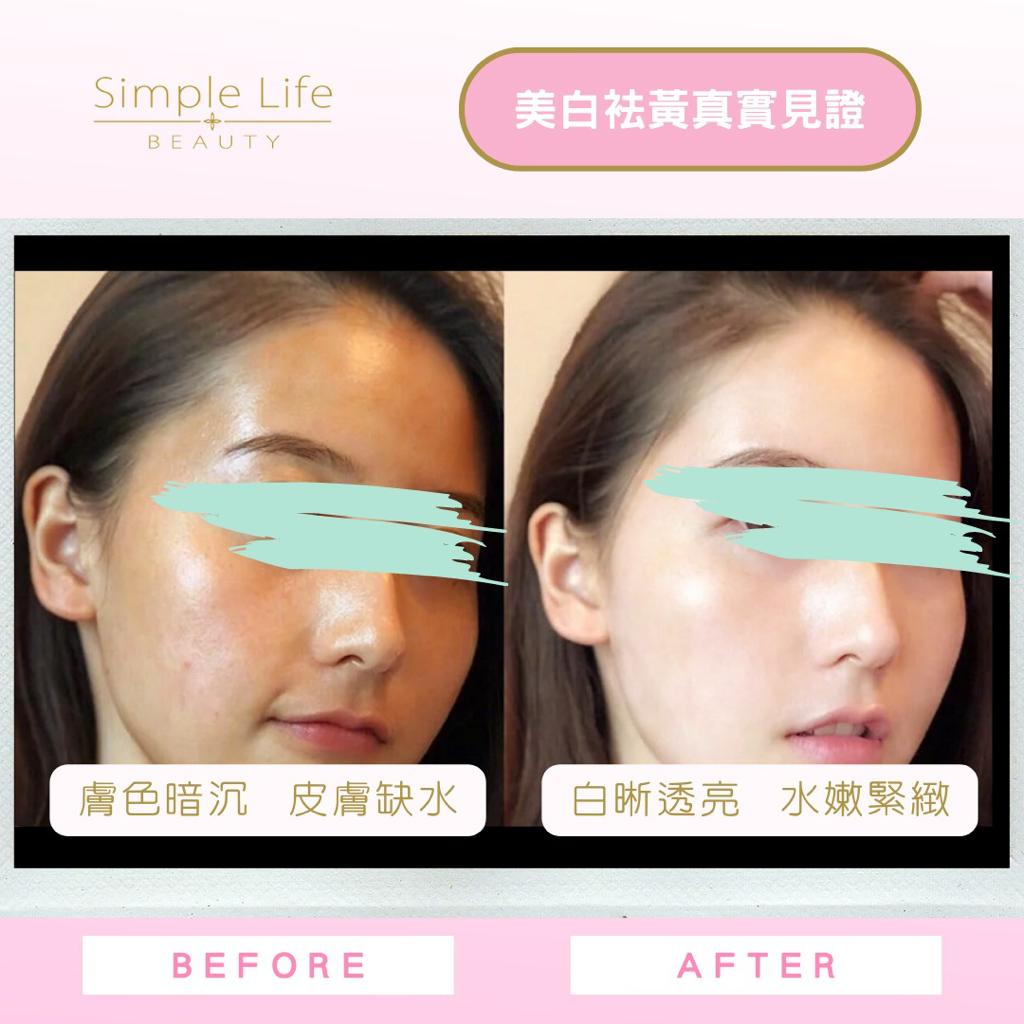O2toderm Facial_美白療程推介