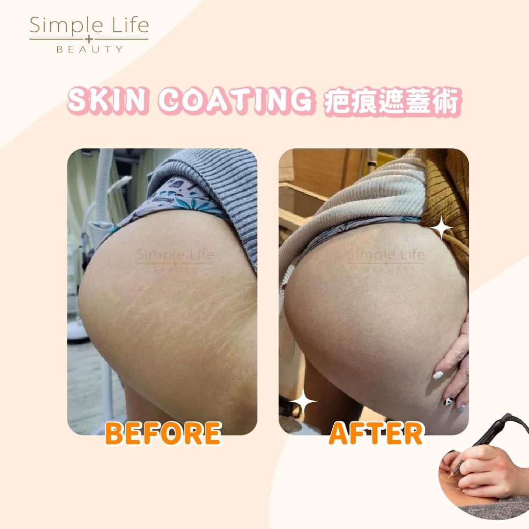 疤痕覆蓋術療程案例2,改善