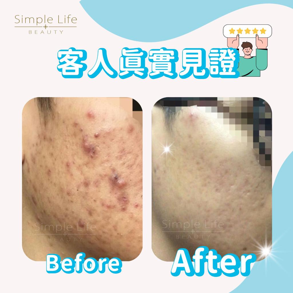 暗瘡消除療程推薦_客人見證1