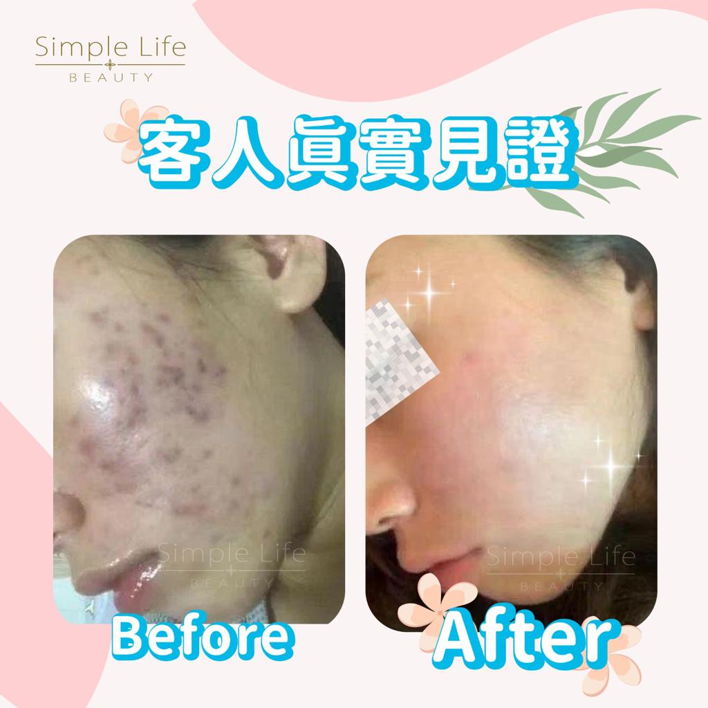 暗瘡消除療程推薦_客人見證4