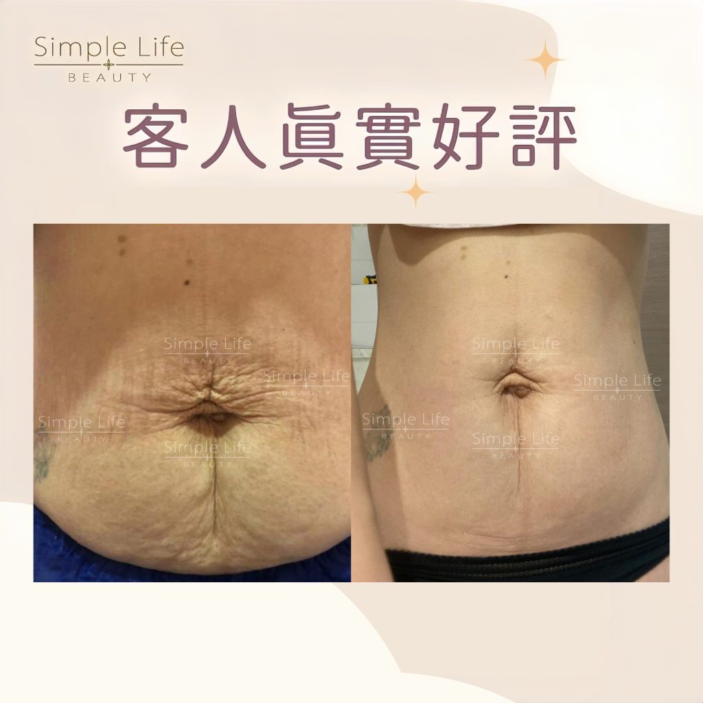 妊娠紋療程第三期消除見證