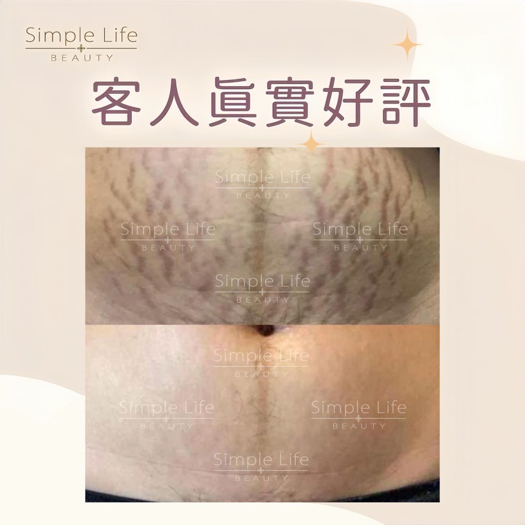 生長紋要怎麼消除?妊娠紋療程,第三期皮膚擴張紋改善見證