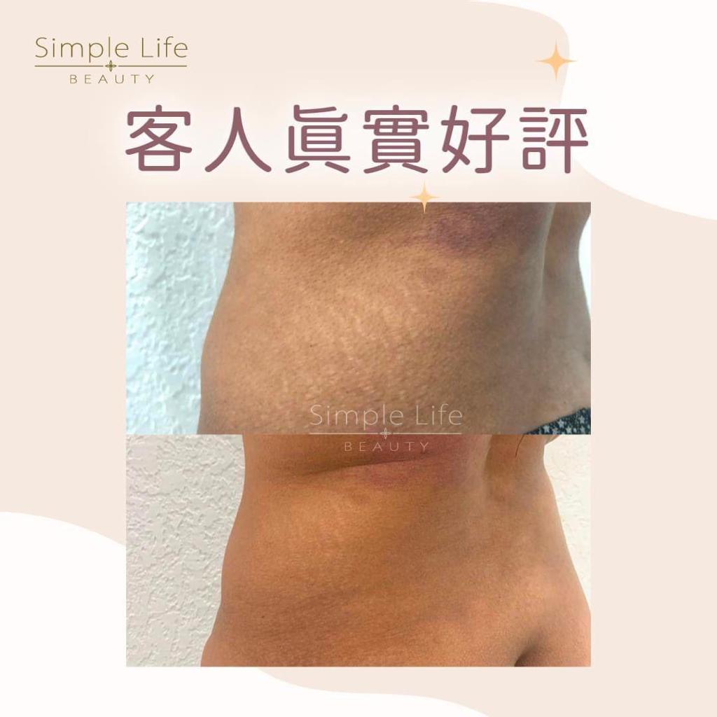 生長紋要怎麼消除?妊娠紋療程,第一期皮膚擴張紋改善見證
