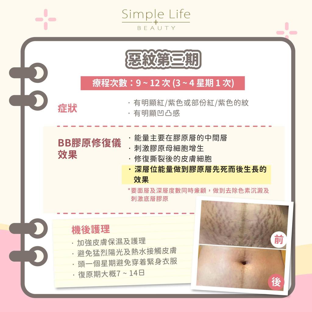 妊娠紋第二期修復方案,如何消除妊娠紋,修復恐紋